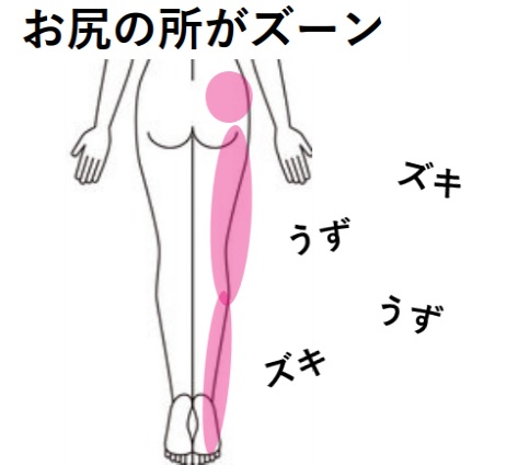 みんなの症例【お尻（坐骨神経痛）】❝疼くような嫌な痛み❞