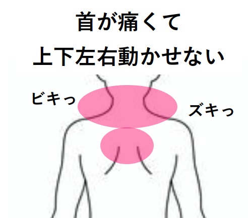 みんなの症例【首痛（頚椎症）】❝寝違えてから1週間痛みが続いている❞