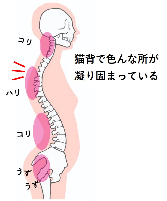 みんなの症例【背（不良姿勢）】❝猫背で年々背中が曲がって背中がポッコリ出てきた❞