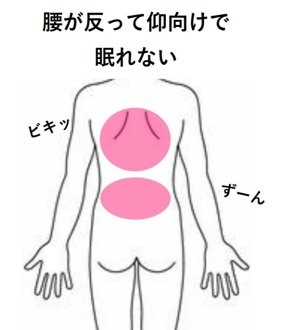 みんなの症例【腰痛（反り腰）】❝仰向けで寝ると腰が反って眠れない❞